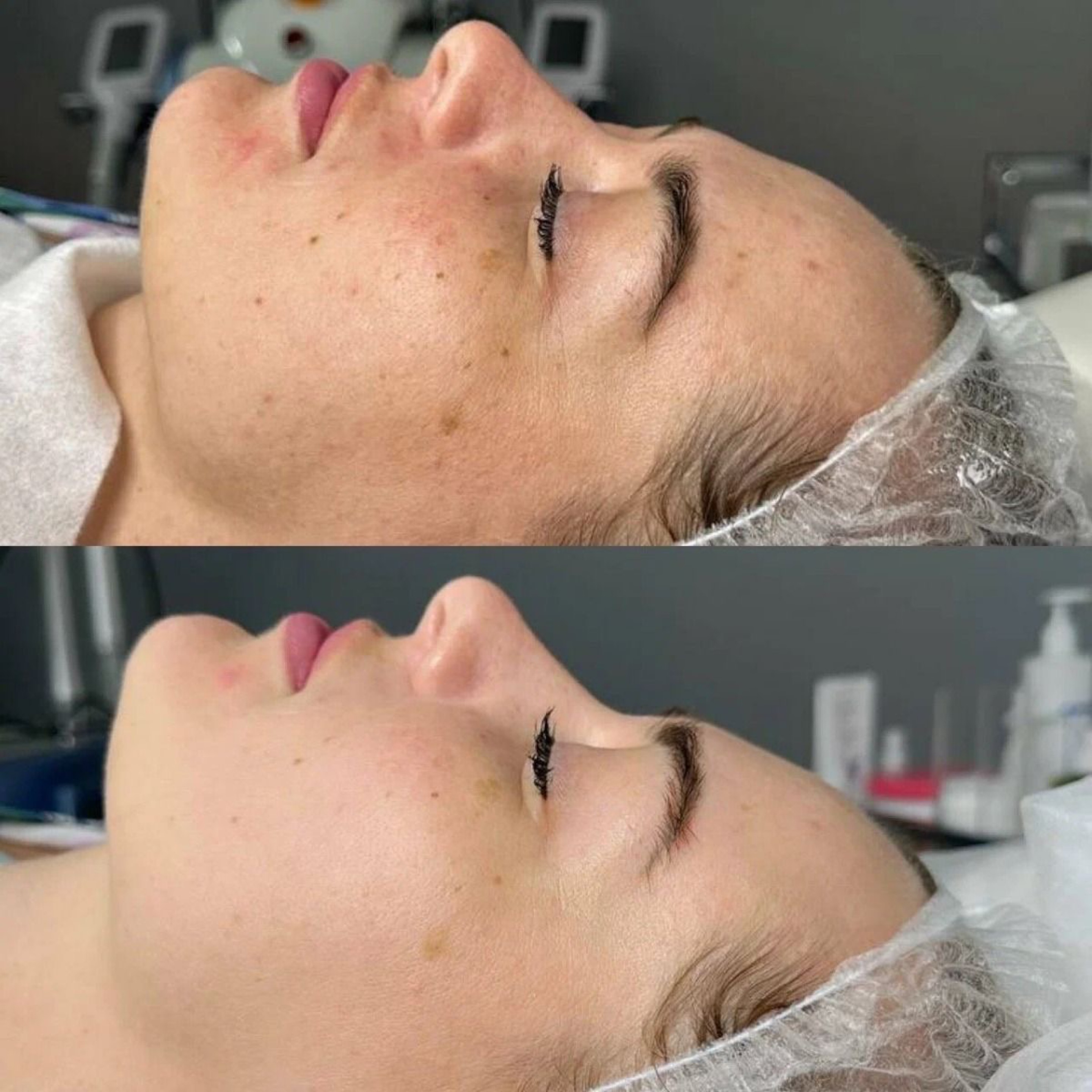 Service: COSMETOLOGY – Carboxytherapy (Face)