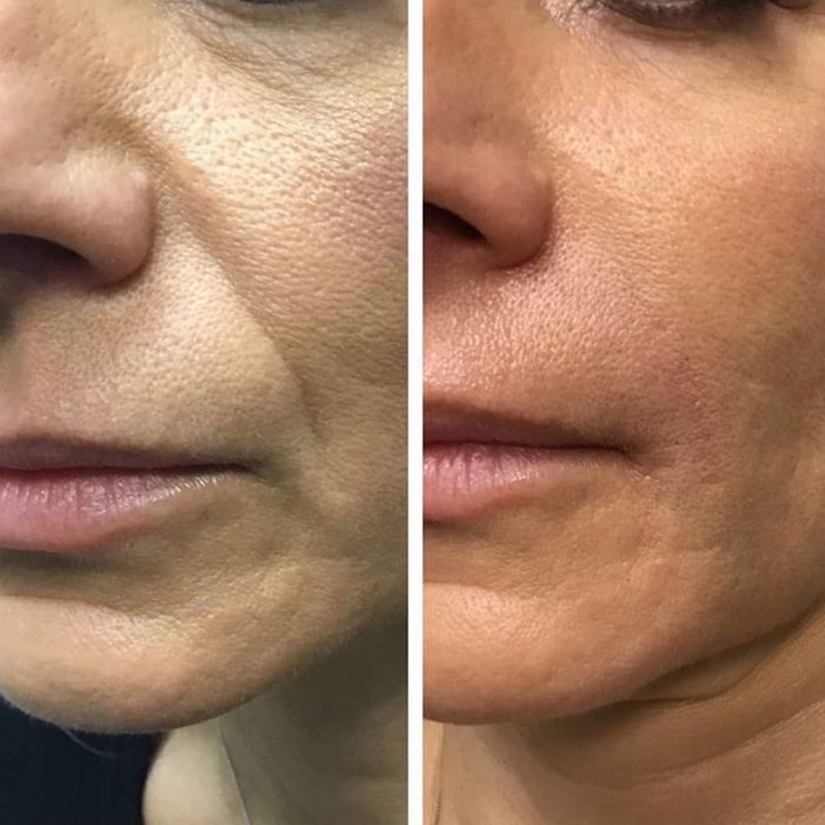 COSMETOLOGY – Microneedling (Face; Mesococktail)