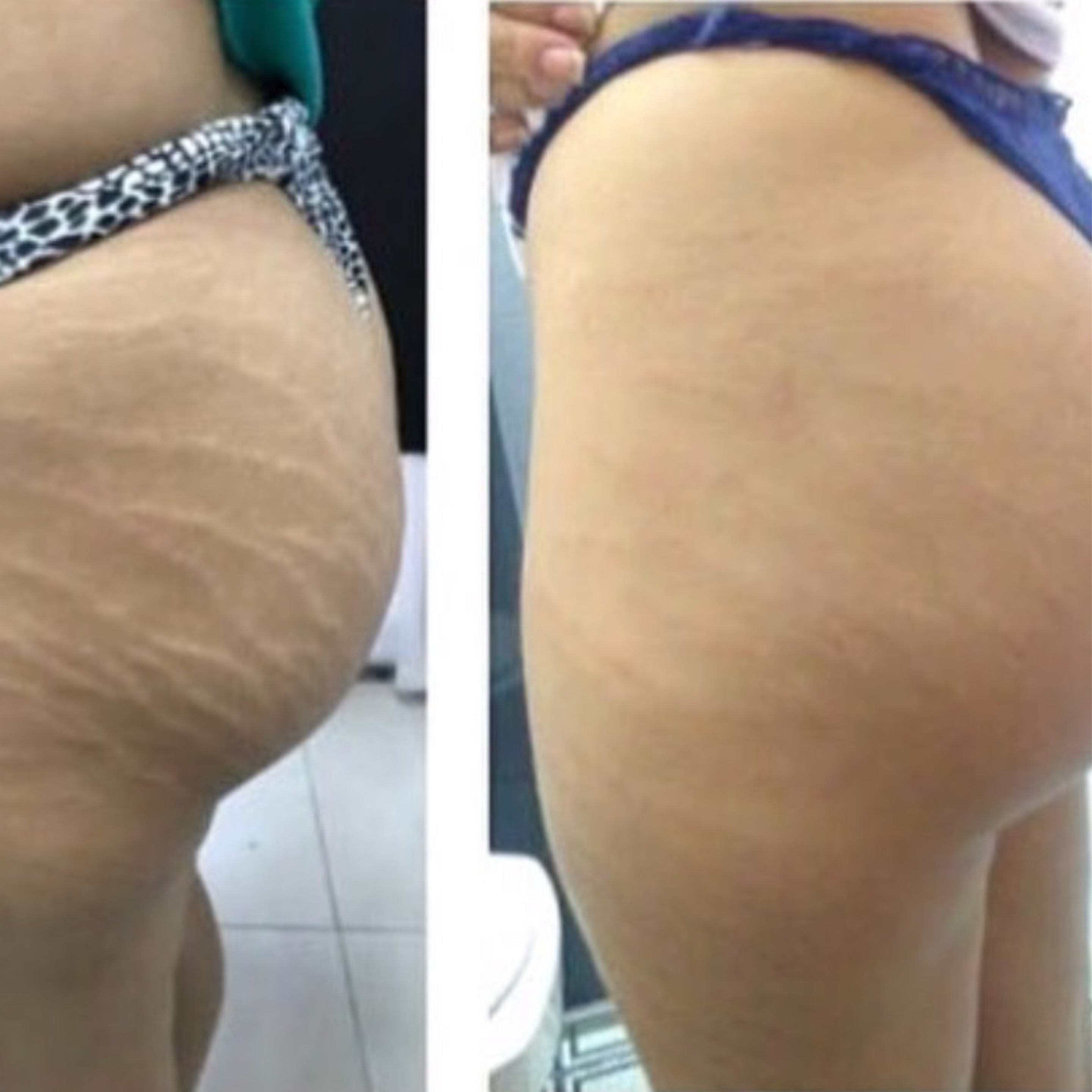 Service: PMU – Camouflage (Scars / Stretch Marks / Blood Vessels)