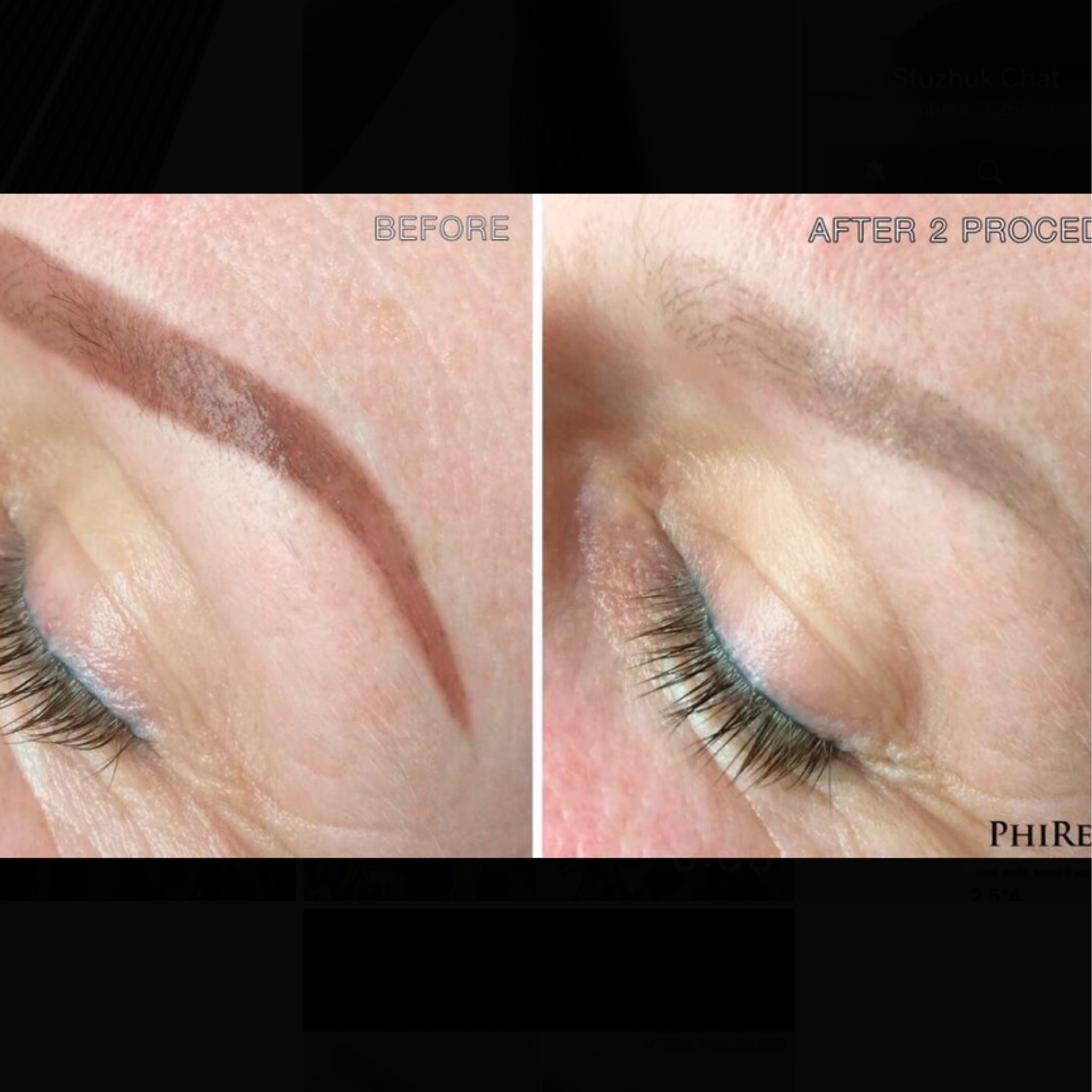 Service: PMU – Removal (Old / Low-Quality PMU; Remover)